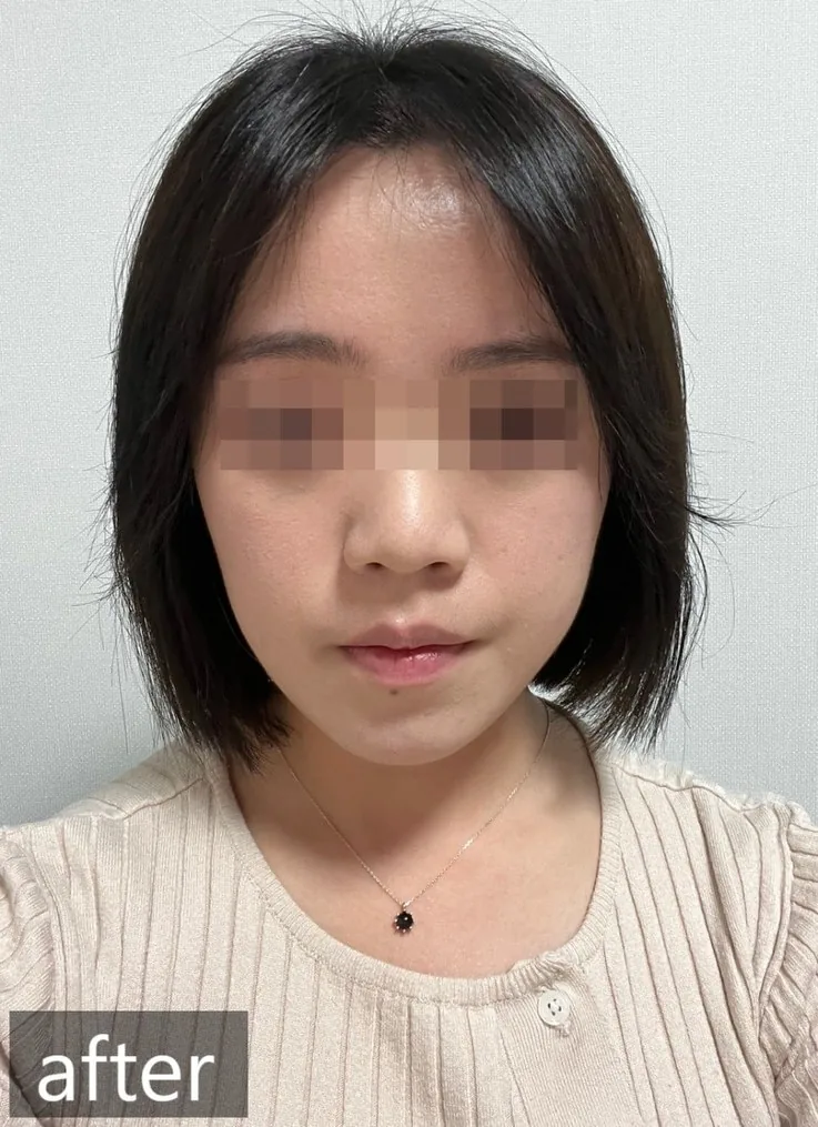 치료 8개월 정면, 8개월 촬영
