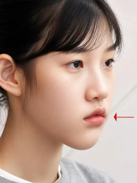 주걱턱 교정 후 반측면, 2019.11.30 촬영